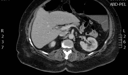 File:Celiac artery compression syndrome (Radiopaedia 24287-24570 B 23).jpg