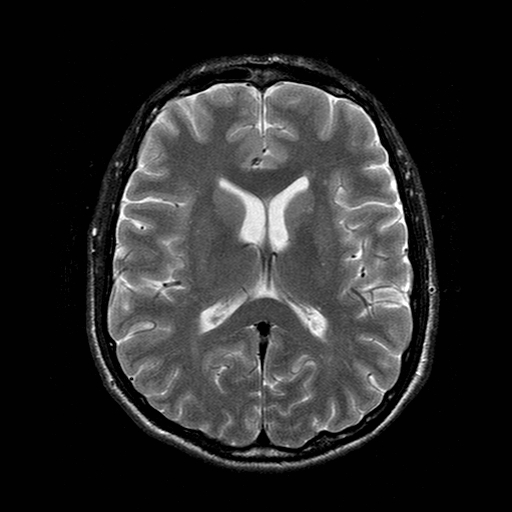File:Central-variant posterior reversible encephalopathy syndrome (PRES) (Radiopaedia 43880-47359 Axial T2 13).jpg