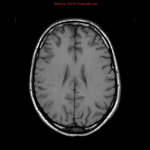 File:Central nervous system vasculitis (Radiopaedia 8410-9235 Axial T1 16).jpg