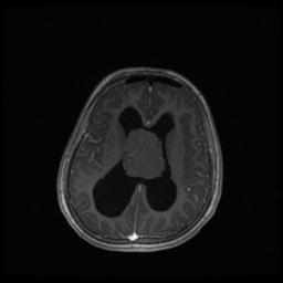 Central neurocytoma (Radiopaedia 30220-30842 Axial T1 C+ 90).jpg