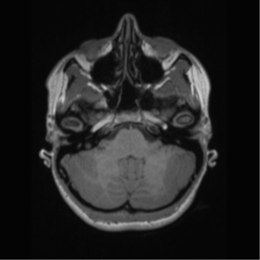 File:Central neurocytoma (Radiopaedia 37664-39557 Axial T1 15).png
