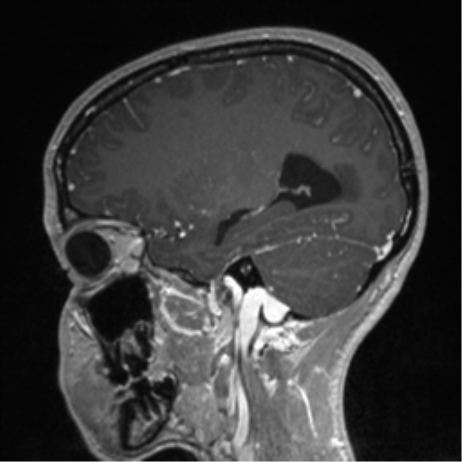 Central neurocytoma (Radiopaedia 37664-39557 Sagittal T1 C+ 66).png