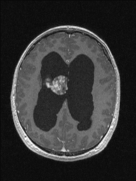 Central neurocytoma (Radiopaedia 56690-63469 Axial T1 C+ 109).jpg