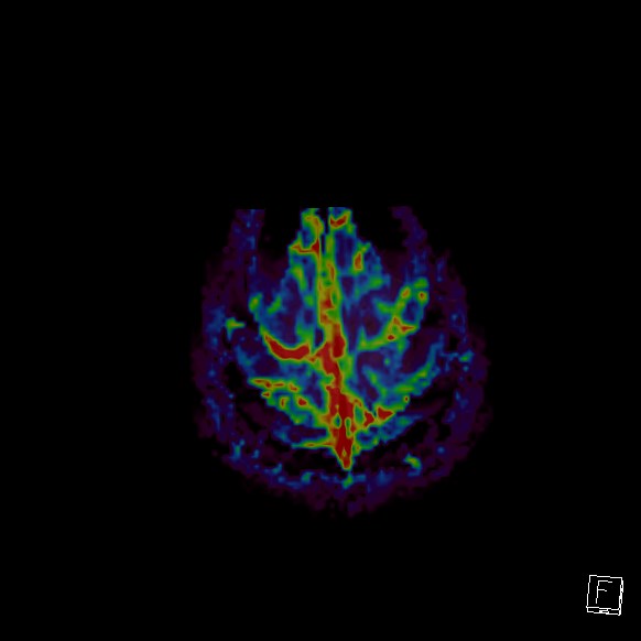 Central neurocytoma (Radiopaedia 84497-99872 Axial Perfusion 20).jpg