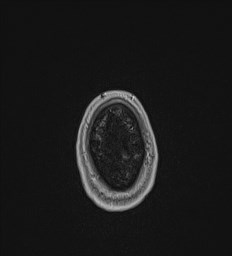 Central neurocytoma (Radiopaedia 84497-99872 Axial T1 C+ 146).jpg