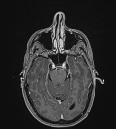 File:Central neurocytoma (Radiopaedia 84497-99872 Axial T1 C+ 50).jpg