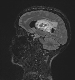 File:Central neurocytoma (Radiopaedia 84497-99872 Sagittal Flair + Gd 65).jpg