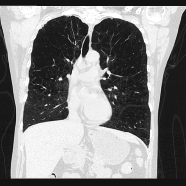 Centrilobular pulmonary emphysema (Radiopaedia 24495-24789 Coronal lung window 33).jpg