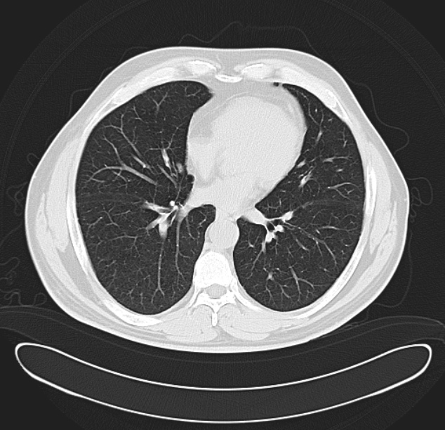 Centrilobular pulmonary emphysema (Radiopaedia 26808-26971 C 27).jpg