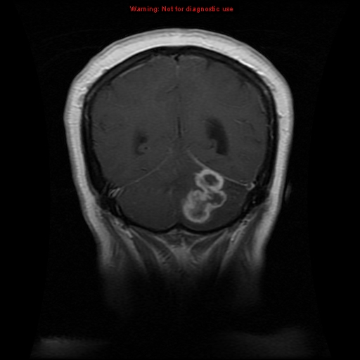 File:Cerebellar abscess (Radiopaedia 10845-11275 Coronal T1 C+ 1).jpg