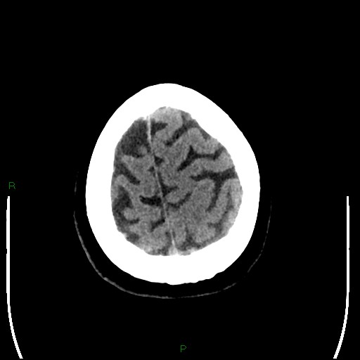 Cerebellar abscess (Radiopaedia 78135-90671 Axial non-contrast 98).jpg