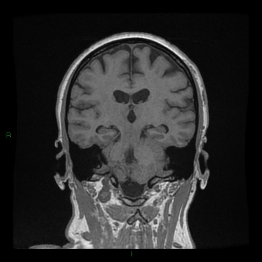 Cerebellar abscess (Radiopaedia 78135-90678 Coronal T1 C+ 96).jpg