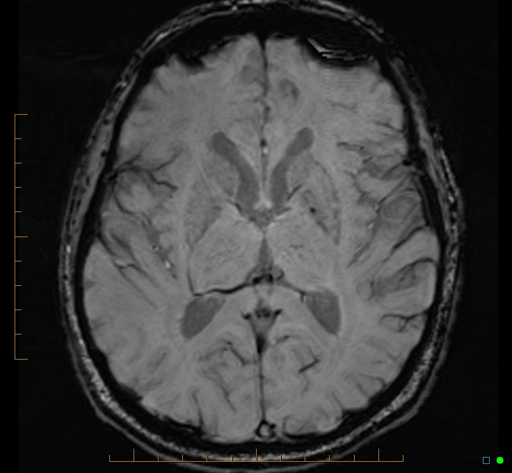 Cerebellar gangliocytoma (Radiopaedia 65377-74422 Axial SWI 30).jpg