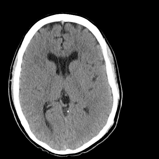 File:Cerebellar infarct due to vertebral artery dissection with posterior fossa decompression (Radiopaedia 82779-97029 Axial non-contrast 14).png