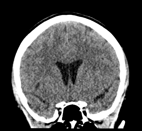 Cerebellar metastases - colorectal adenocarcinoma (Radiopaedia 40947-43652 Coronal non-contrast 40).png