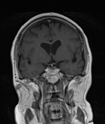 File:Cerebellar metastasis (Radiopaedia 54578-60810 Coronal T1 C+ 16).png
