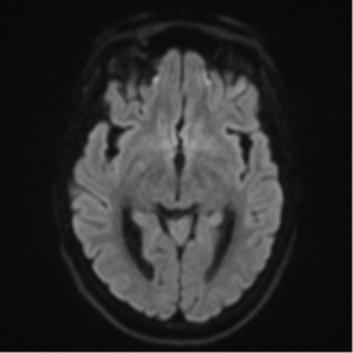 Cerebellar metastasis - adenocarcinoma lung (Radiopaedia 63184-71715 Axial DWI 42).png