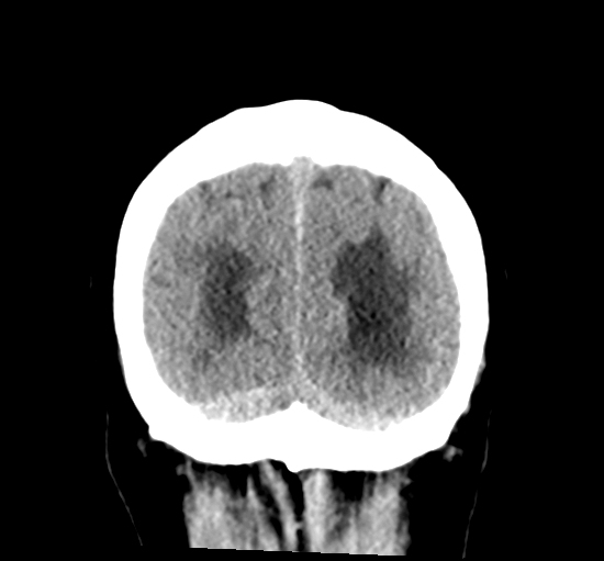 File:Cerebellar metastasis from lung adenocarcinoma (Radiopaedia 86690-102828 Coronal non-contrast 36).png