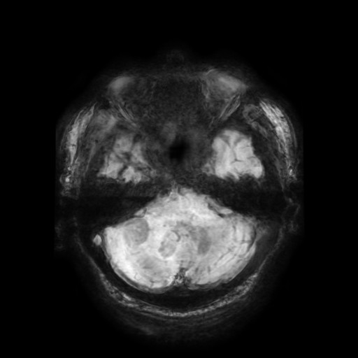 Cerebellar metastasis of pulmonary adenocarcinoma, cavernous venous malformation, and developmental venous anomaly (Radiopaedia 85827-101661 Axial SWI 53).jpg