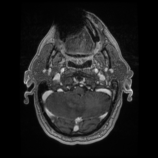 File:Cerebellar metastasis of pulmonary adenocarcinoma, cavernous venous malformation, and developmental venous anomaly (Radiopaedia 85827-101661 Axial T1 C+ 21).jpg