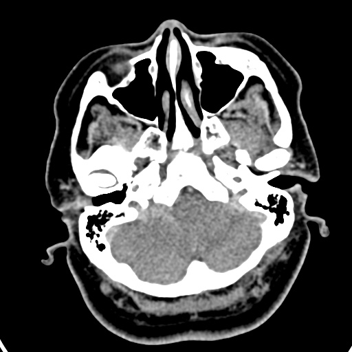 Cerebellopontine angle meningioma (Radiopaedia 35181-36714 A 42).jpg
