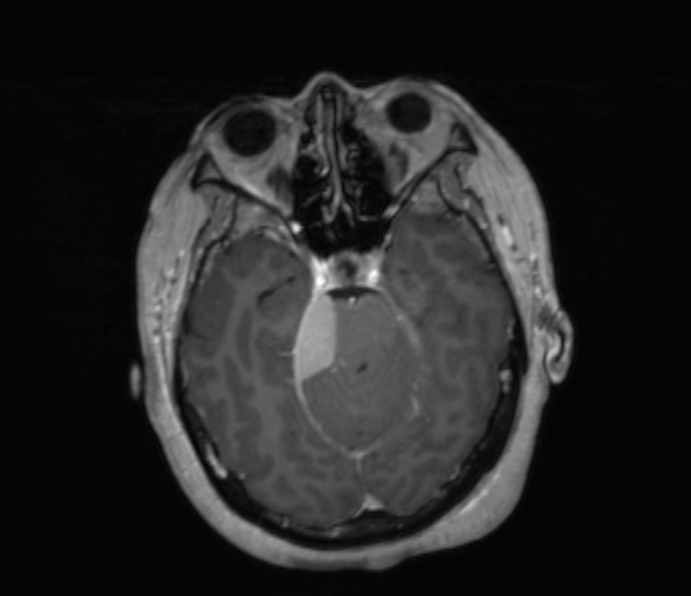 Cerebellopontine angle meningioma (Radiopaedia 35181-36715 Axial T1 C+ 37).jpg