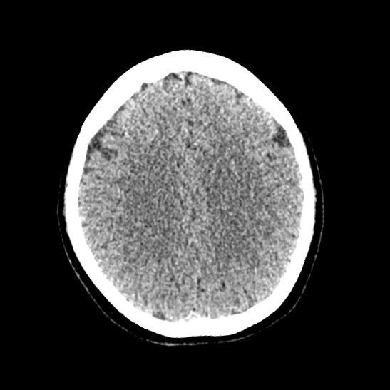 Cerebellopontine angle meningioma (Radiopaedia 53561-59592 Axial non-contrast 46).jpg