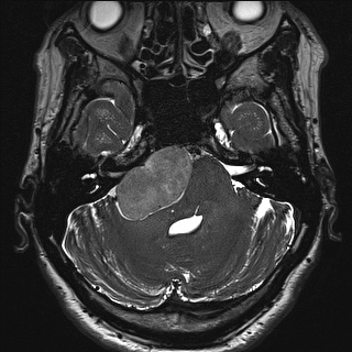Cerebellopontine angle meningioma (Radiopaedia 72983-83680 Axial FIESTA 32).jpg