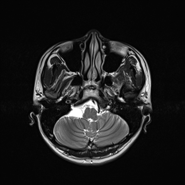 Cerebral abscess (Radiopaedia 24212-24478 Axial T2 16).jpg