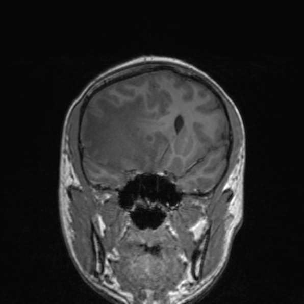 Cerebral abscess (Radiopaedia 24212-24478 Coronal T1 84).jpg
