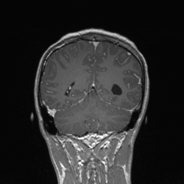 File:Cerebral abscess (Radiopaedia 24212-24478 Coronal T1 C+ 150).jpg