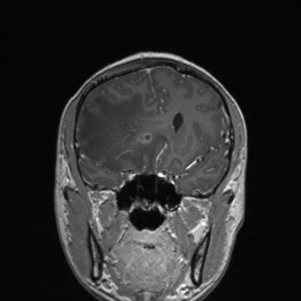 Cerebral abscess (Radiopaedia 24212-24478 Coronal T1 C+ 85).jpg