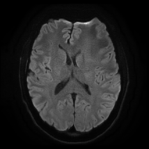 Cerebral abscess (Radiopaedia 57774-64740 Axial DWI 16).png