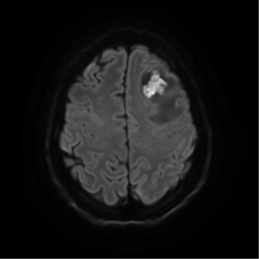 Cerebral abscess (Radiopaedia 57774-64740 Axial DWI 23).png