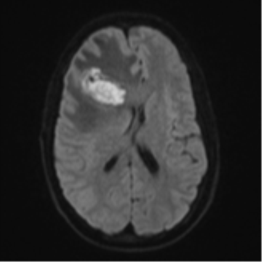 File:Cerebral abscess (Radiopaedia 60342-68009 Axial DWI 57).png