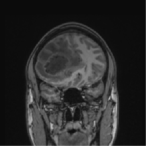 Cerebral abscess (Radiopaedia 60342-68009 Coronal T1 37).png
