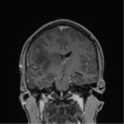 File:Cerebral abscess (Radiopaedia 60342-68009 H 25).png