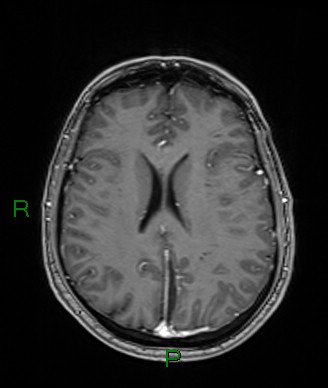 Cerebral abscess and subdural empyema (Radiopaedia 84436-99779 Axial T1 C+ 35).jpg