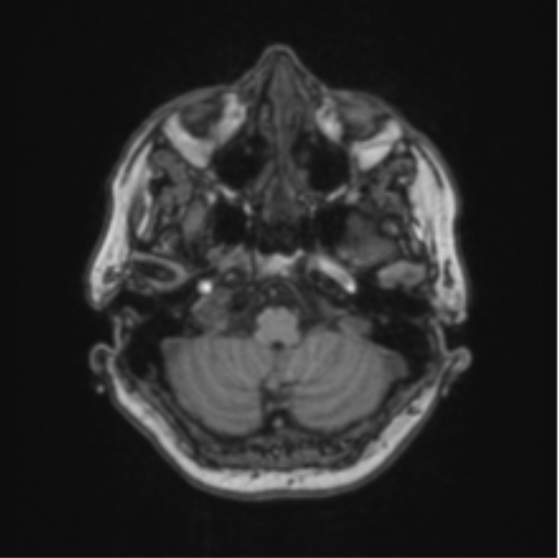 Cerebral abscess from pulmonary arteriovenous malformation (Radiopaedia 86275-102291 Axial T1 16).png