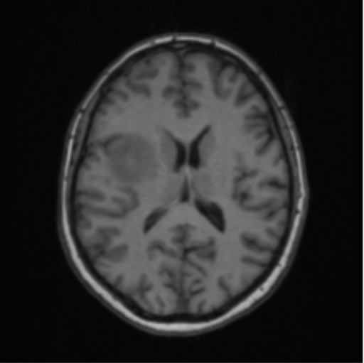 Cerebral abscess from pulmonary arteriovenous malformation (Radiopaedia 86275-102291 Axial T1 44).png