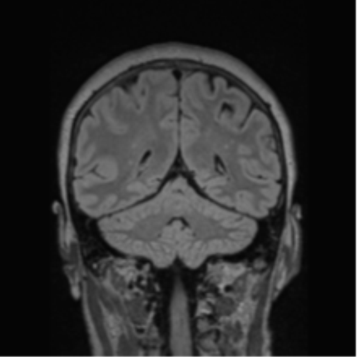 Cerebral abscess from pulmonary arteriovenous malformation (Radiopaedia 86275-102291 Coronal FLAIR 32).png