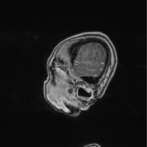 Cerebral abscess from pulmonary arteriovenous malformation (Radiopaedia 86275-102291 Sagittal T1 C+ 70).png