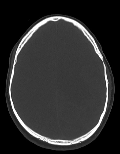 Cerebral abscesses (Radiopaedia 70458-80568 Axial bone window 41).jpg