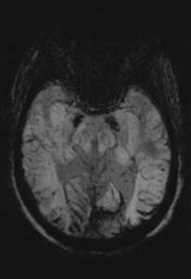 File:Cerebral amyloid angiopathy (Radiopaedia 29129-29518 Axial SWI MIP 13).jpg