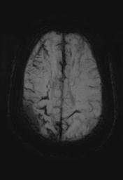 File:Cerebral amyloid angiopathy (Radiopaedia 29129-29518 Axial SWI MIP 23).jpg