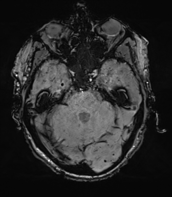 File:Cerebral amyloid angiopathy (Radiopaedia 46082-50433 Axial SWI 23).png