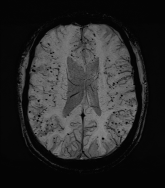 File:Cerebral amyloid angiopathy (Radiopaedia 46082-50433 Axial SWI MIP 49).png