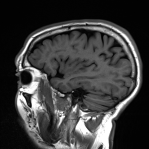 File:Cerebral amyloid angiopathy (Radiopaedia 46082-50433 Sagittal T1 7).png