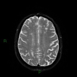 Cerebral amyloid angiopathy (Radiopaedia 77506-89664 Axial DWI 48).jpg