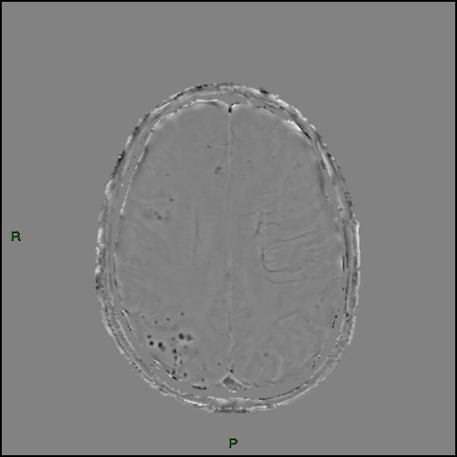 Cerebral amyloid angiopathy (Radiopaedia 77506-89664 H 69).jpg